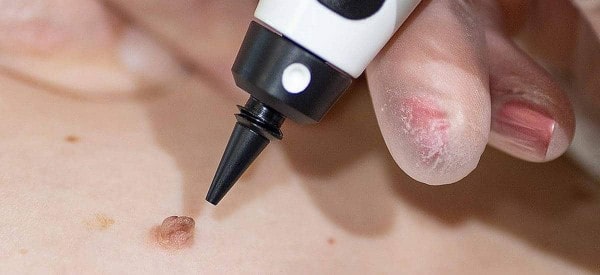 After Skin Tag Removal Stourbridge