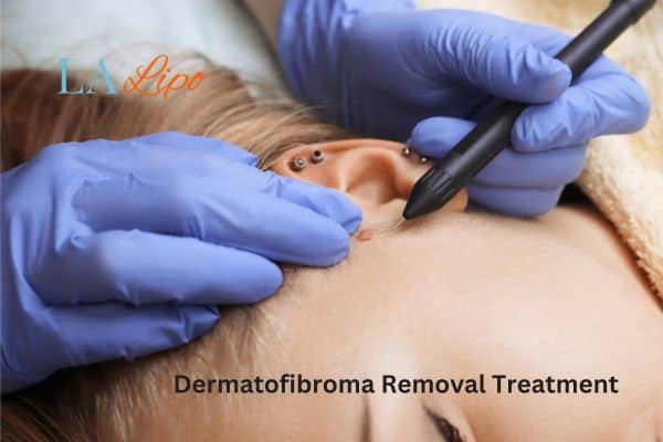 Dermatofibroma Removal Treatment Stourbridge