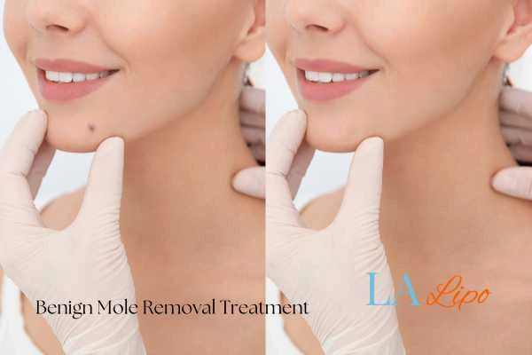 woman's before and after mole removal Stourbridge results
