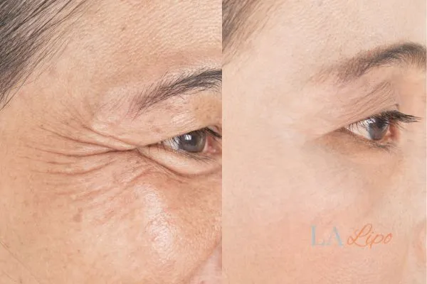 Before and after results of woman - HI-fu wrinkles reduction treatment Stourbridge