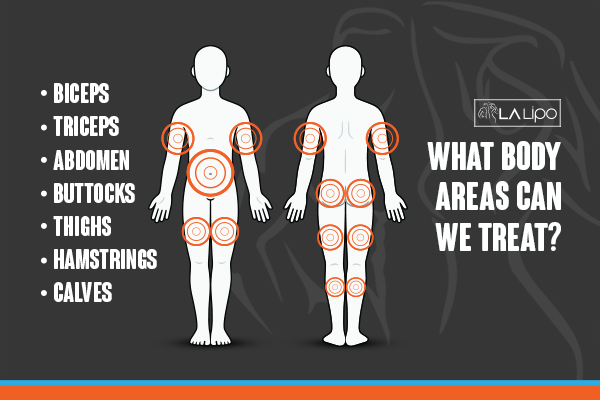 Graphic to show areas you can have LA-EMS Body Sculpting Stourbridge treatment.