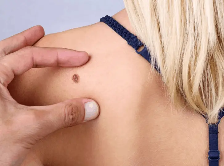 woman having mole removal Stourbridge consultation before treatment.
