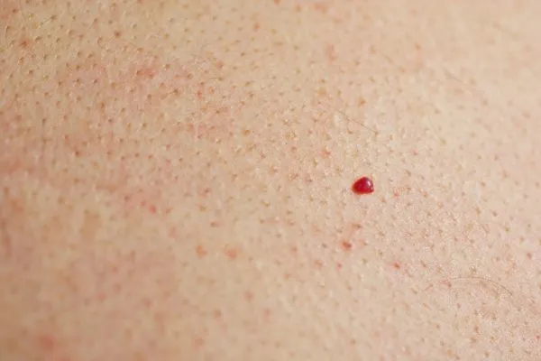 close up of a cherry angioma Stourbridge