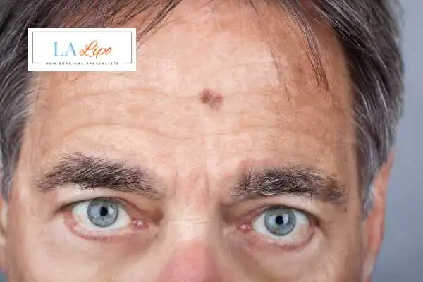 Solar Lentigo Removal Stourbridge image of man with mark on his forehead