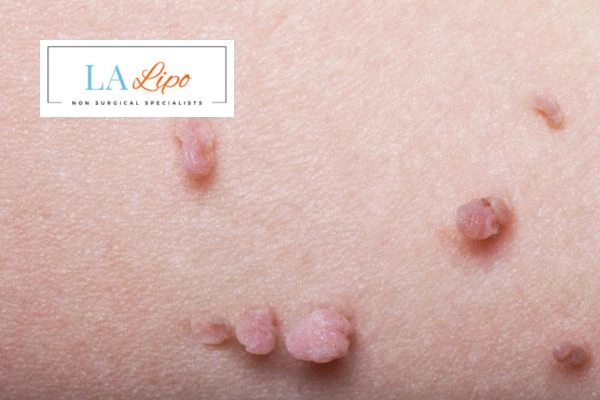 Does cryopen skin tag removal Stourbridge hurt? Find out now call our team today!