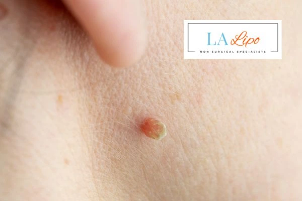 Book skin tag removal Stourbridge today speak to our team now!