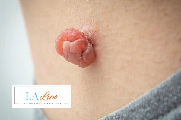 Interested in skin tag removal Stourbridge? Concerned about the pain? Find out more today!