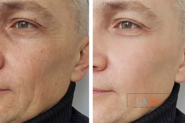 See the amazing results of Morpheus8 Treatment Stourbridge!