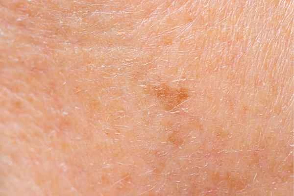 close up picture of age spots Stourbridge