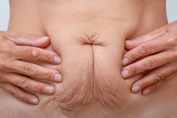 Should I Combine Diastasis Recti Treatment with Body Contouring for Better Results Stourbridge?